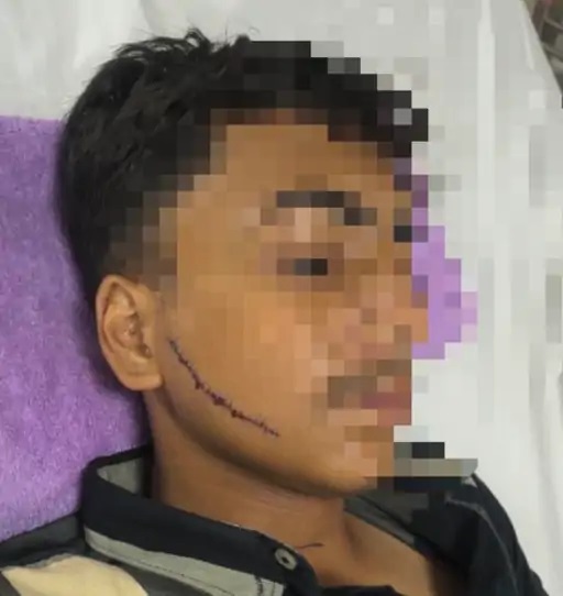 बात करने से इंकार करने पर 10वीं के स्टूडेंट के मुंह पर क्लासमेंट ने मारे ब्लेड, 23 टांके लगे