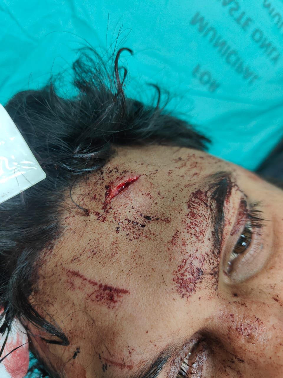 इंगेजमेंट पार्टी से लौटे युवक पर पथराव,सुभम घायल, सेक्टर-34 पुलिस जांच में जुटी