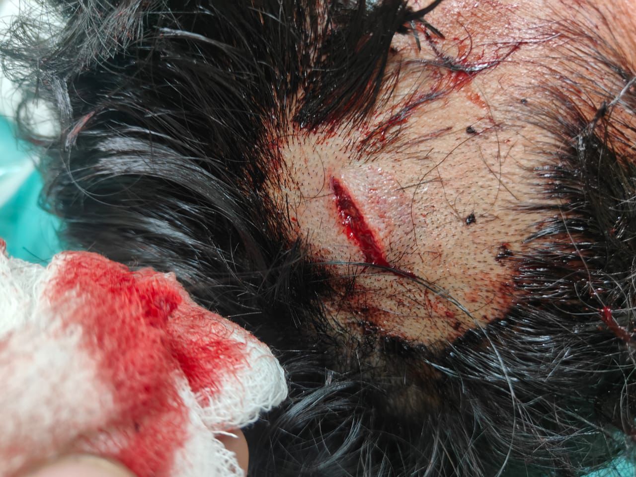 इंगेजमेंट पार्टी से लौटे युवक पर पथराव,सुभम घायल, सेक्टर-34 पुलिस जांच में जुटी